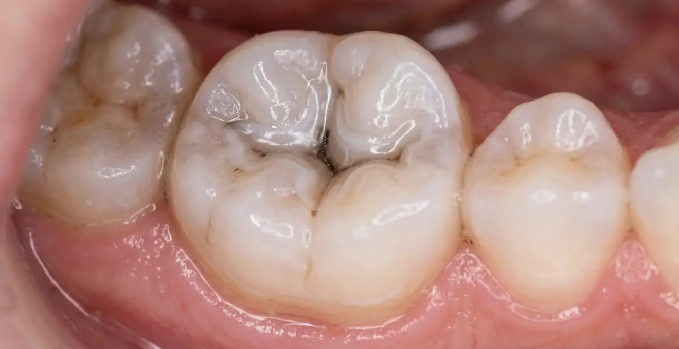 Détail macro d'une molaire d'enfant avec scellement préventif